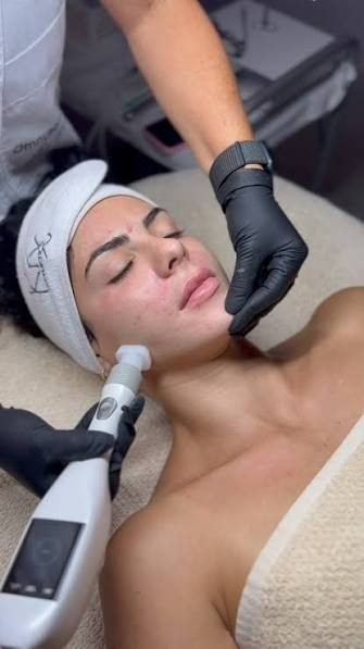 Jet Plasma plasma froid à l'Institut SkinCare Project, Etterbeek Bruxelles